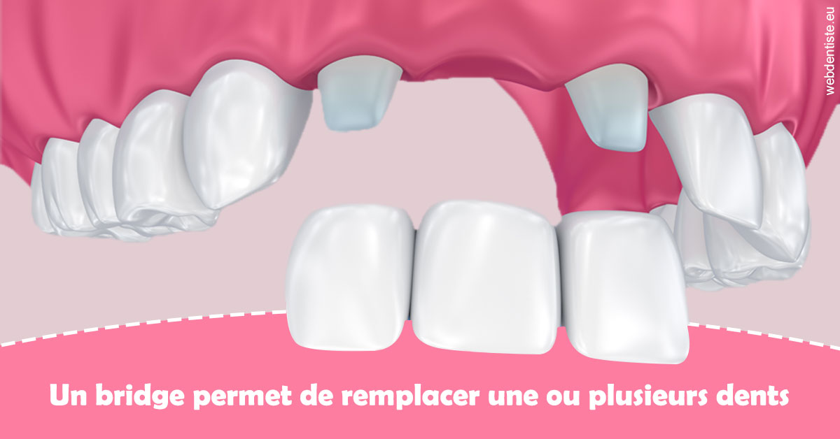 https://dr-lenoble-traore-marie-madeleine.chirurgiens-dentistes.fr/Bridge remplacer dents 2