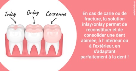 https://dr-lenoble-traore-marie-madeleine.chirurgiens-dentistes.fr/L'INLAY ou l'ONLAY 2